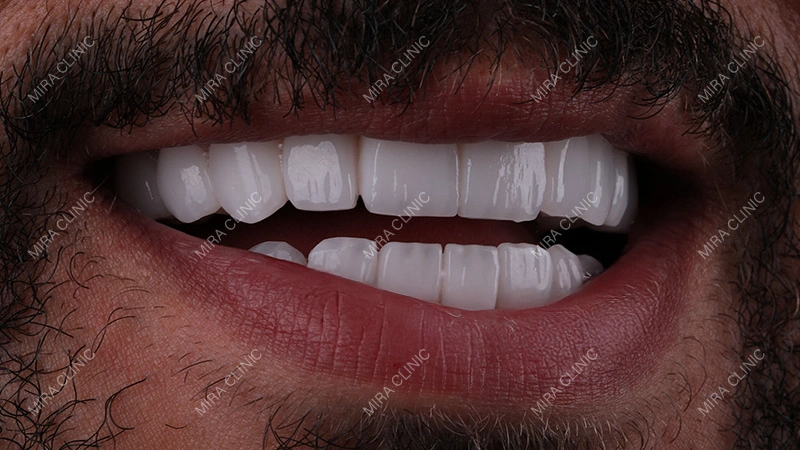 24 zirconium crowns before after